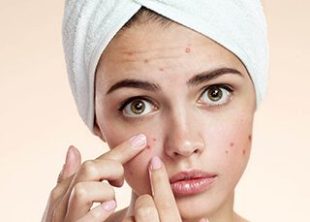 Acne Treatment Acne Treatment in Lahore